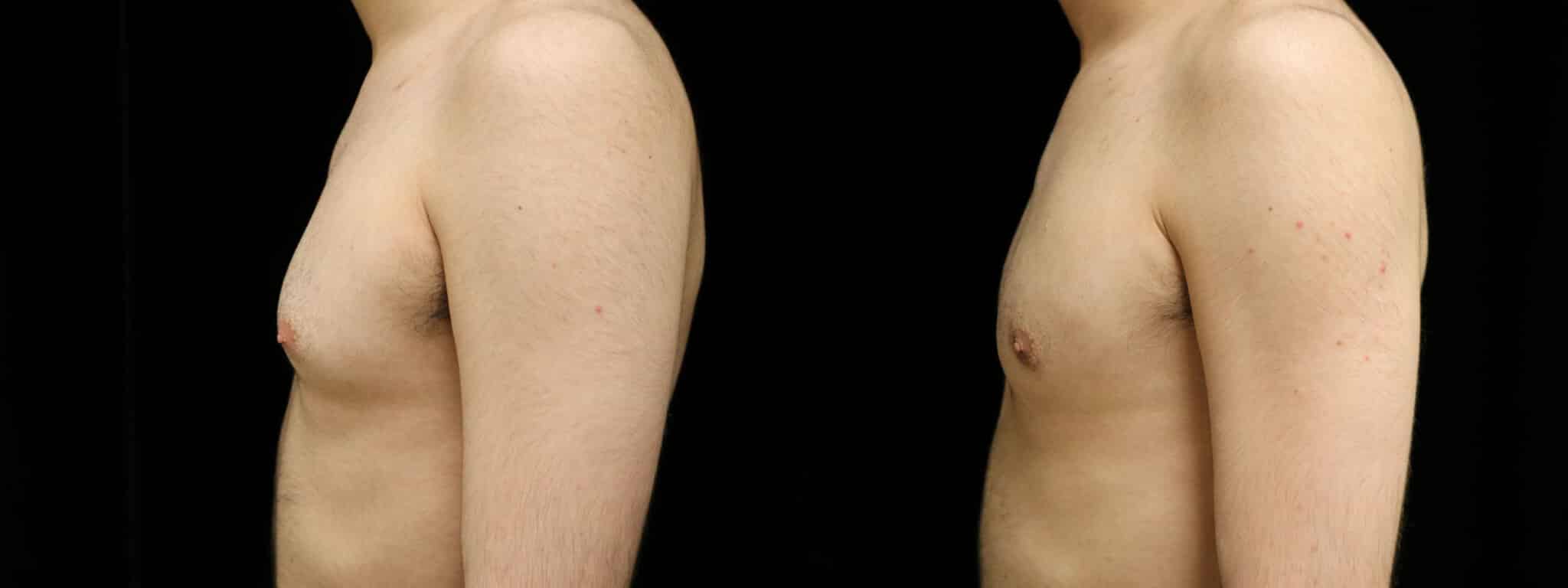 Gynecomastia Patient 2 Before & After Details