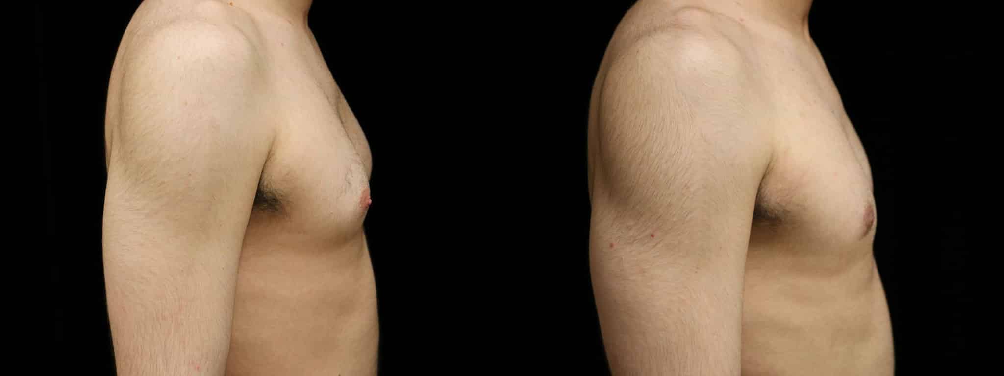 Gynecomastia Patient 2 Before & After Details