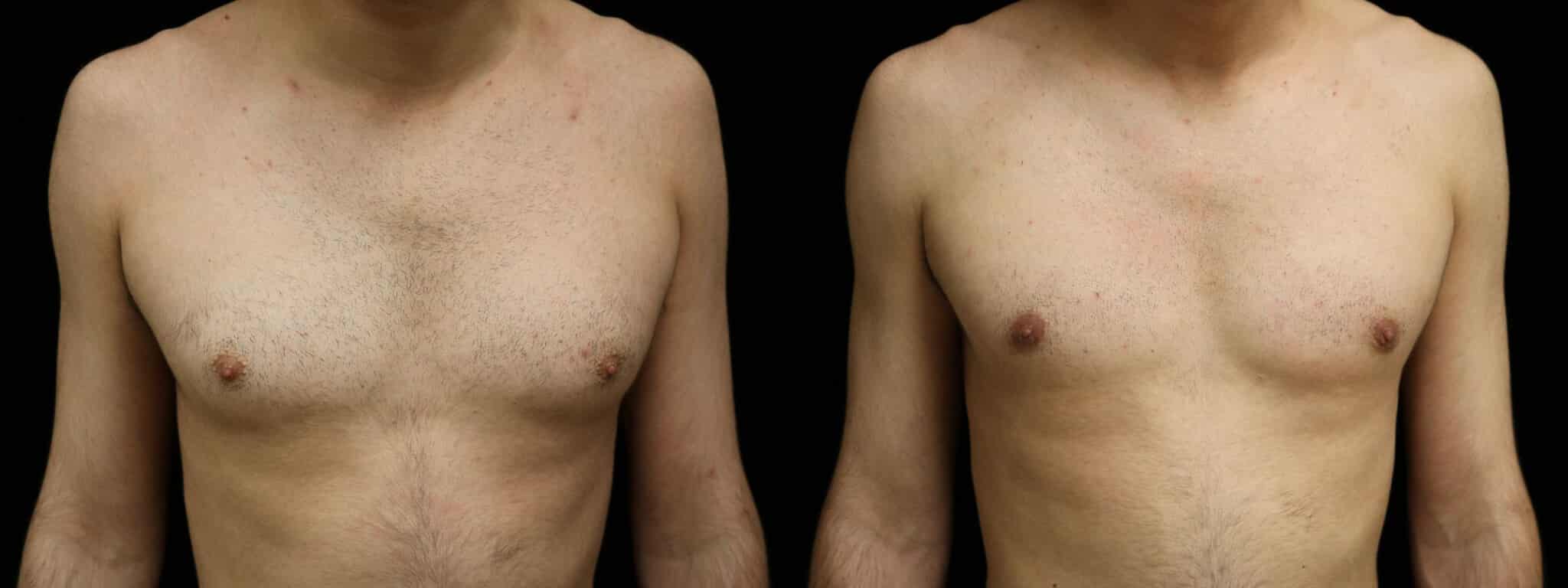 Gynecomastia Patient 2 Before & After