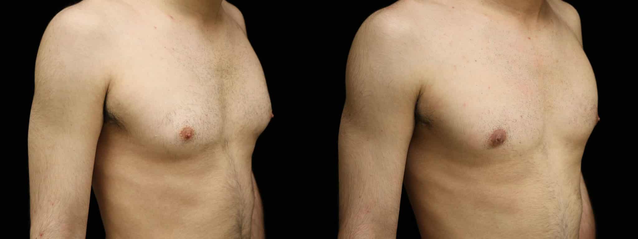 Gynecomastia Patient 2 Before & After Details