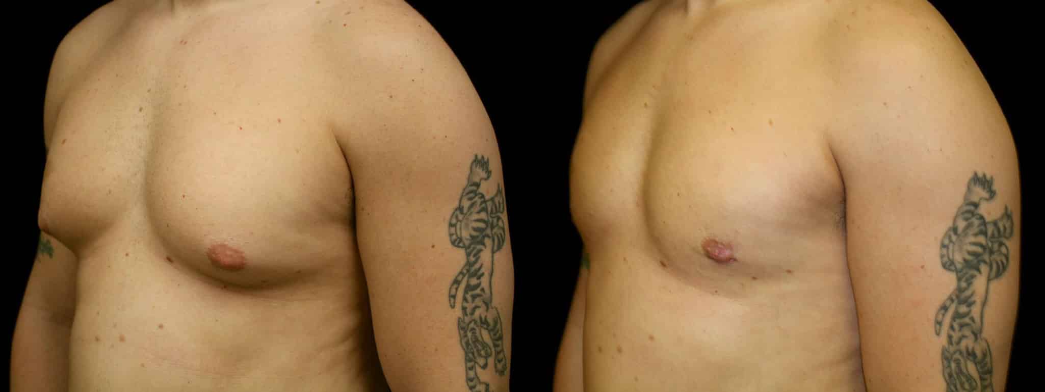 Gynecomastia Patient 5 Before & After Details