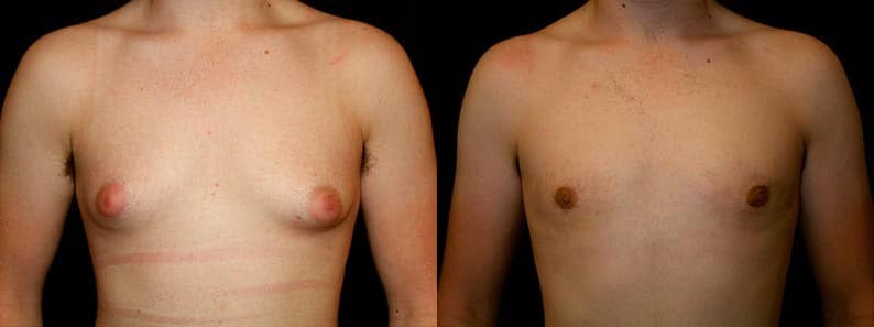 Gynecomastia Patient 11 Before & After