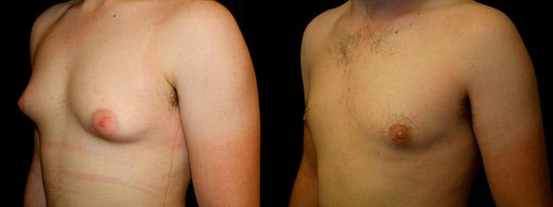 Gynecomastia Patient 11 Before & After Details