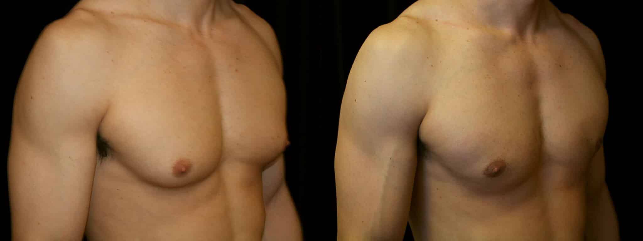 Gynecomastia Patient 20 Before & After Details