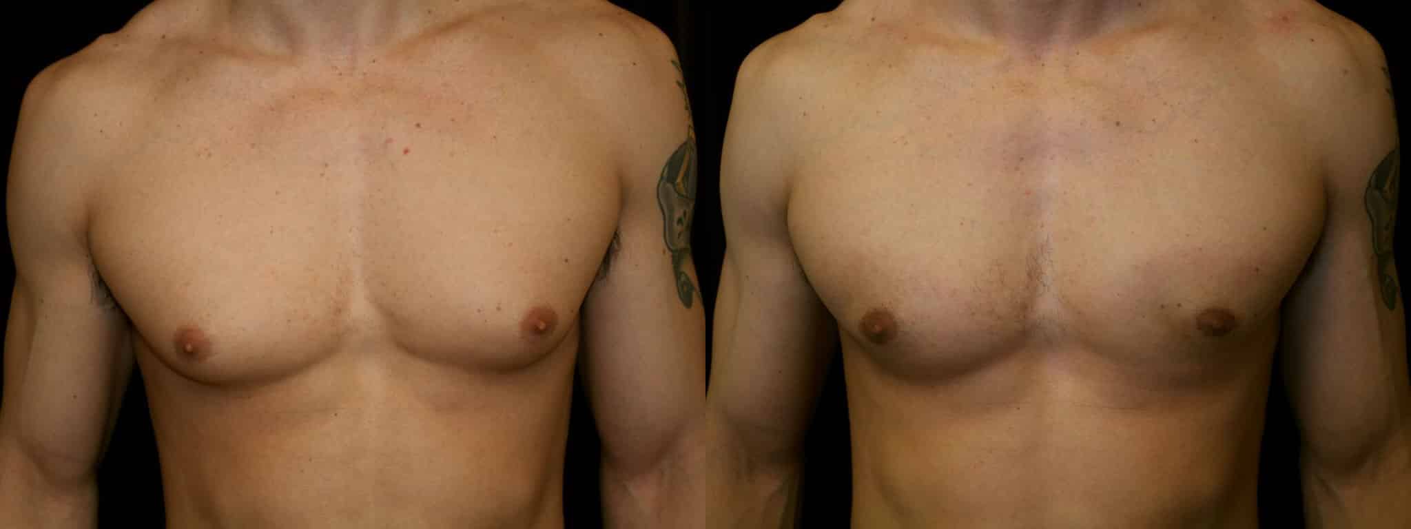 Gynecomastia Patient 20 Before & After