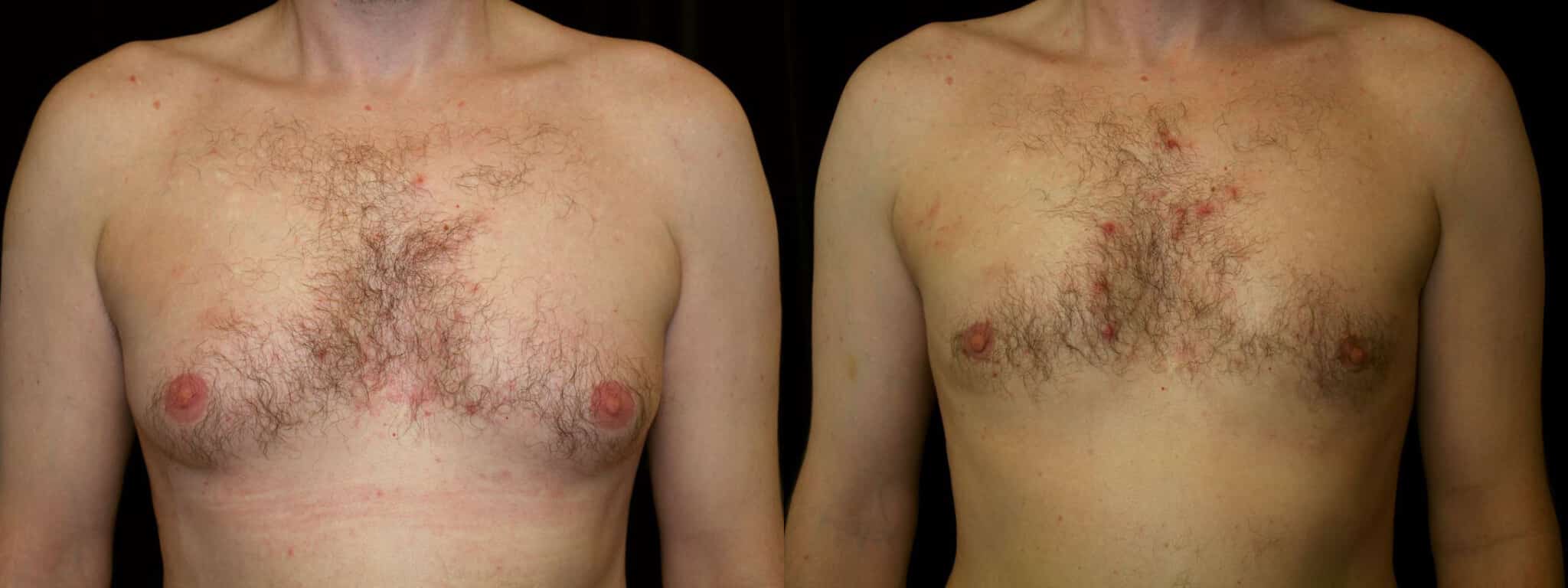 Gynecomastia Patient 4 Before & After