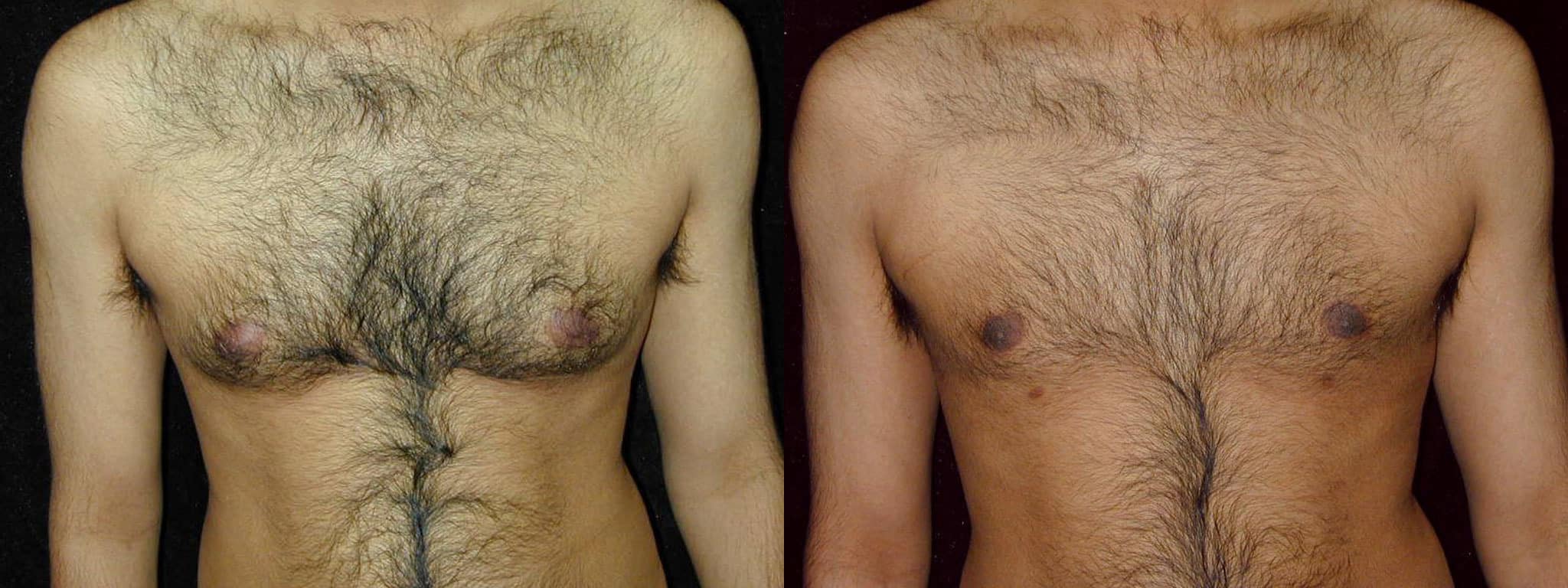 Gynecomastia Patient 10 Before & After