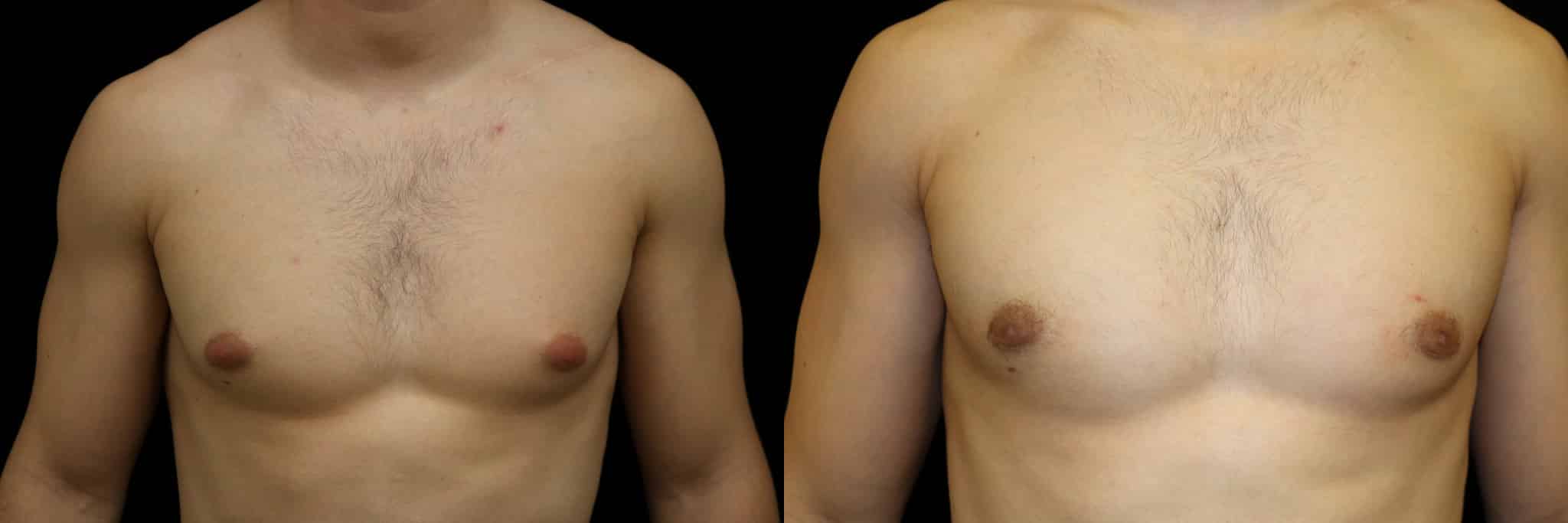 Gynecomastia Patient 16 Before & After