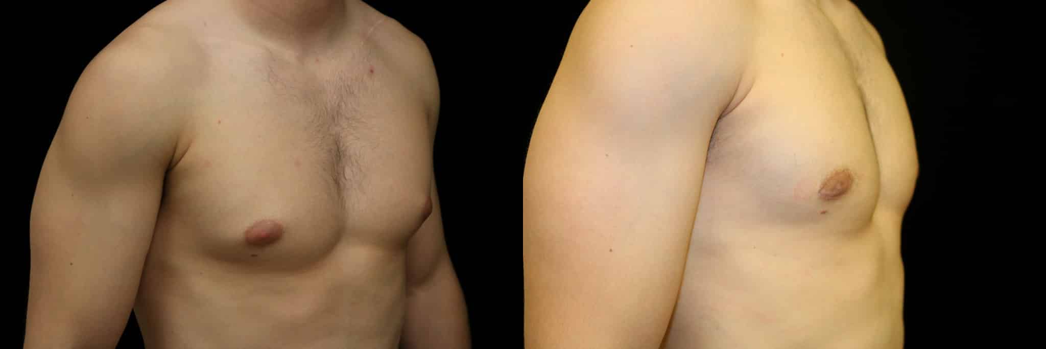 Gynecomastia Patient 16 Before & After Details