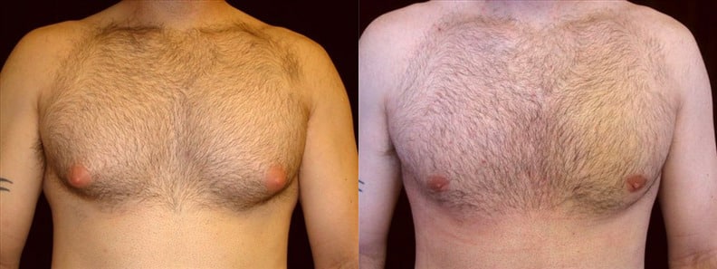 Gynecomastia Patient 2 Before & After