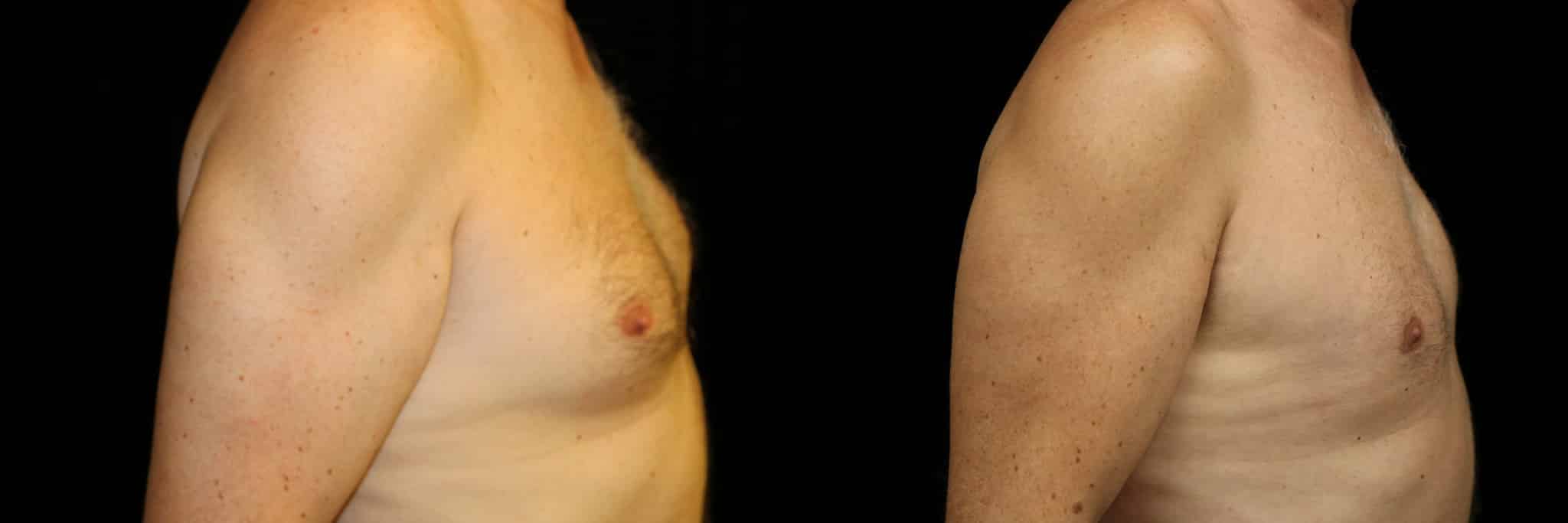Gynecomastia Patient 15 Before & After Details