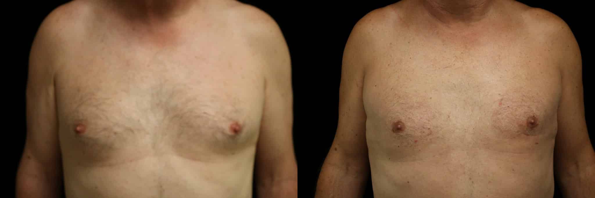 Gynecomastia Patient 15 Before & After