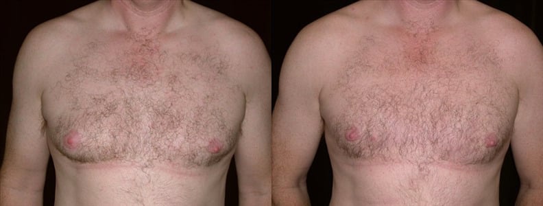 Gynecomastia Patient 19 Before & After