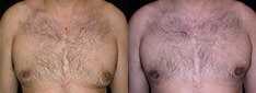 Gynecomastia Patient 11 Before & After