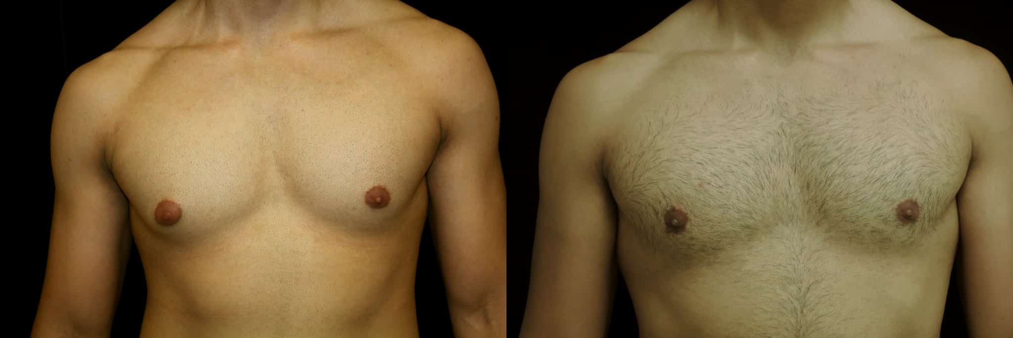 Gynecomastia Patient 13 Before & After