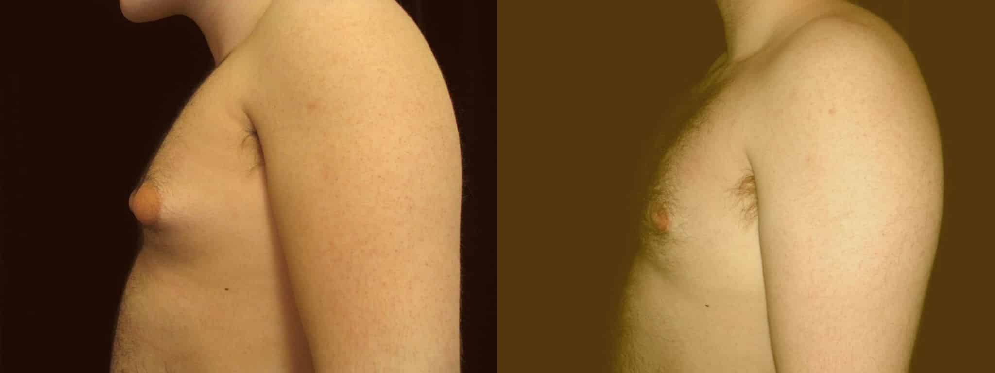 Gynecomastia Patient 12 Before & After Details