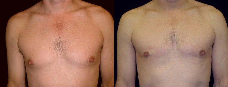 Gynecomastia Patient 4 Before & After