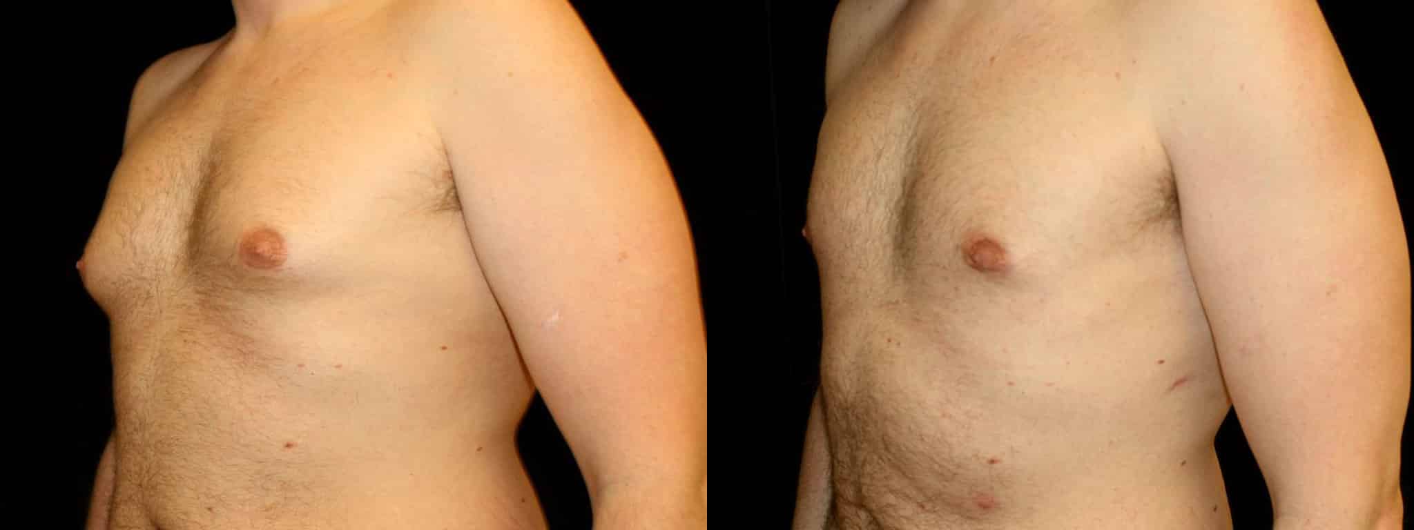 Gynecomastia Patient 16 Before & After Details