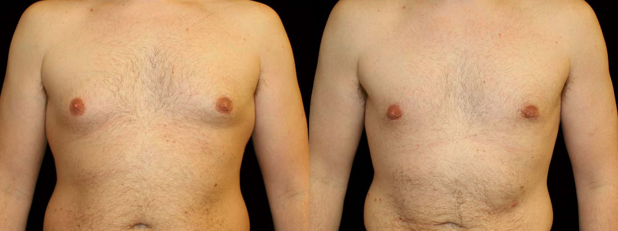 Gynecomastia Patient 16 Before & After