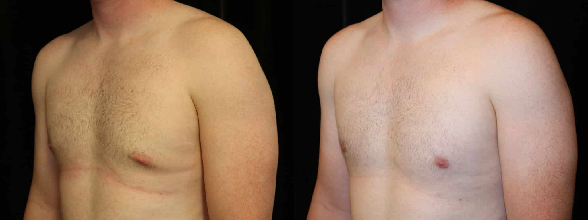 Gynecomastia Patient 17 Before & After Details