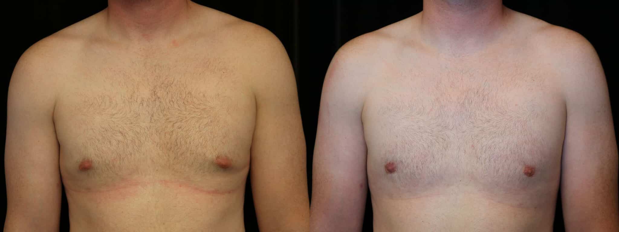 Gynecomastia Patient 17 Before & After