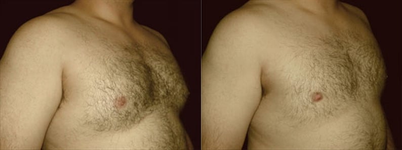 Gynecomastia Patient 10 Before & After Details