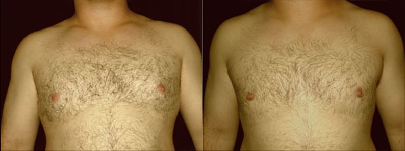 Gynecomastia Patient 10 Before & After