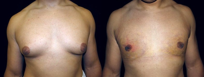 Gynecomastia Patient 21 Before & After