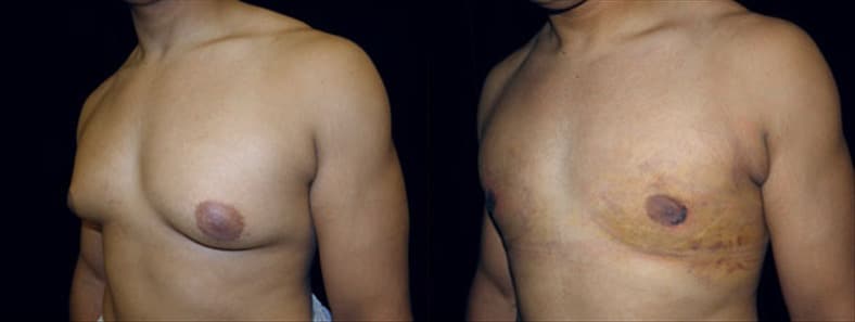 Gynecomastia Patient 21 Before & After Details
