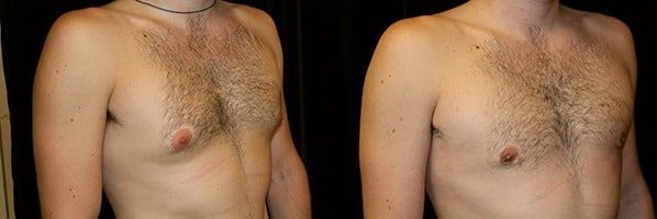 Gynecomastia Patient 13 Before & After Details