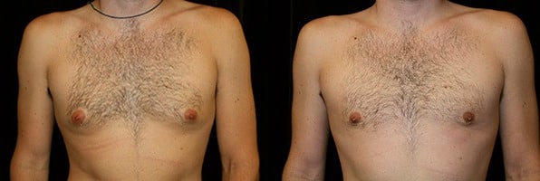 Gynecomastia Patient 13 Before & After