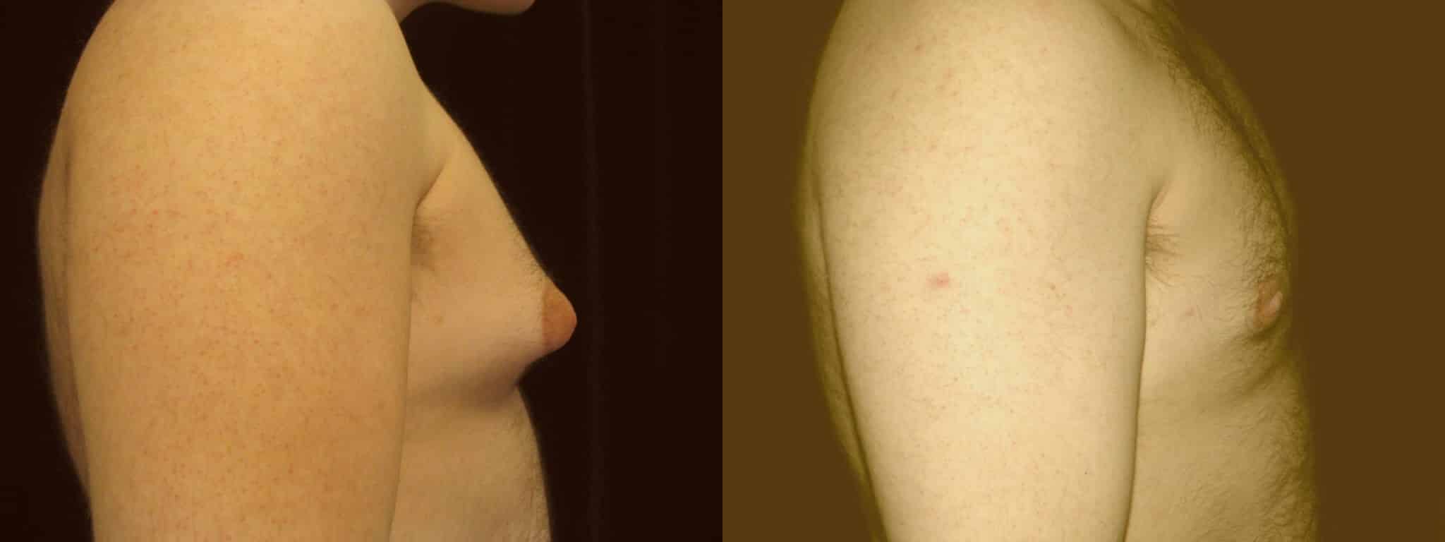 Gynecomastia Patient 12 Before & After