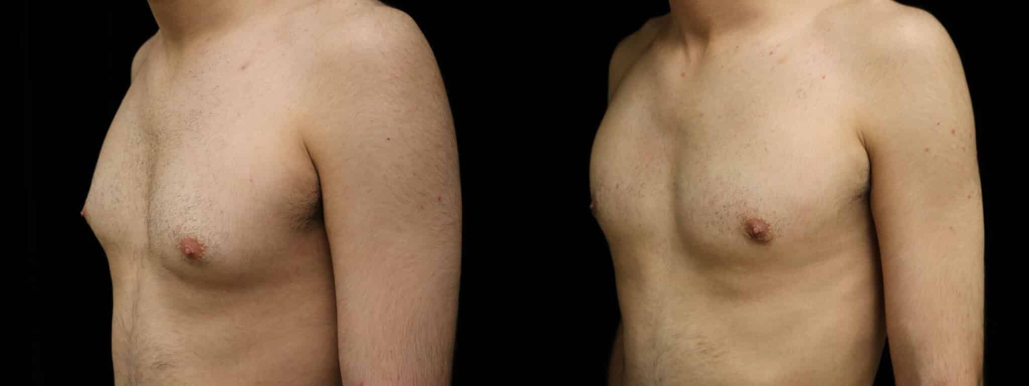 Gynecomastia Patient 2 Before & After Details