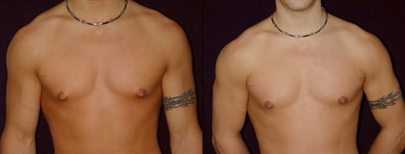 Gynecomastia Patient 5 Before & After