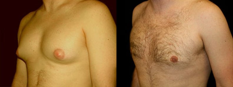 Gynecomastia Patient 16 Before & After Details