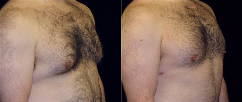 Gynecomastia Patient 21 Before & After