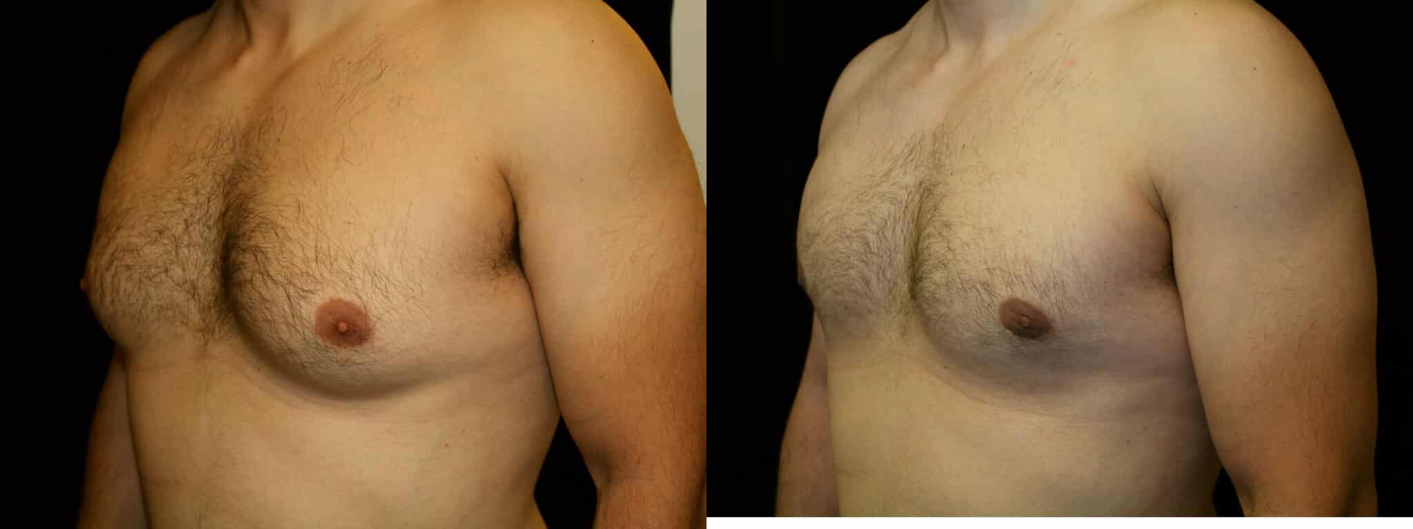 Gynecomastia Patient 14 Before & After Details