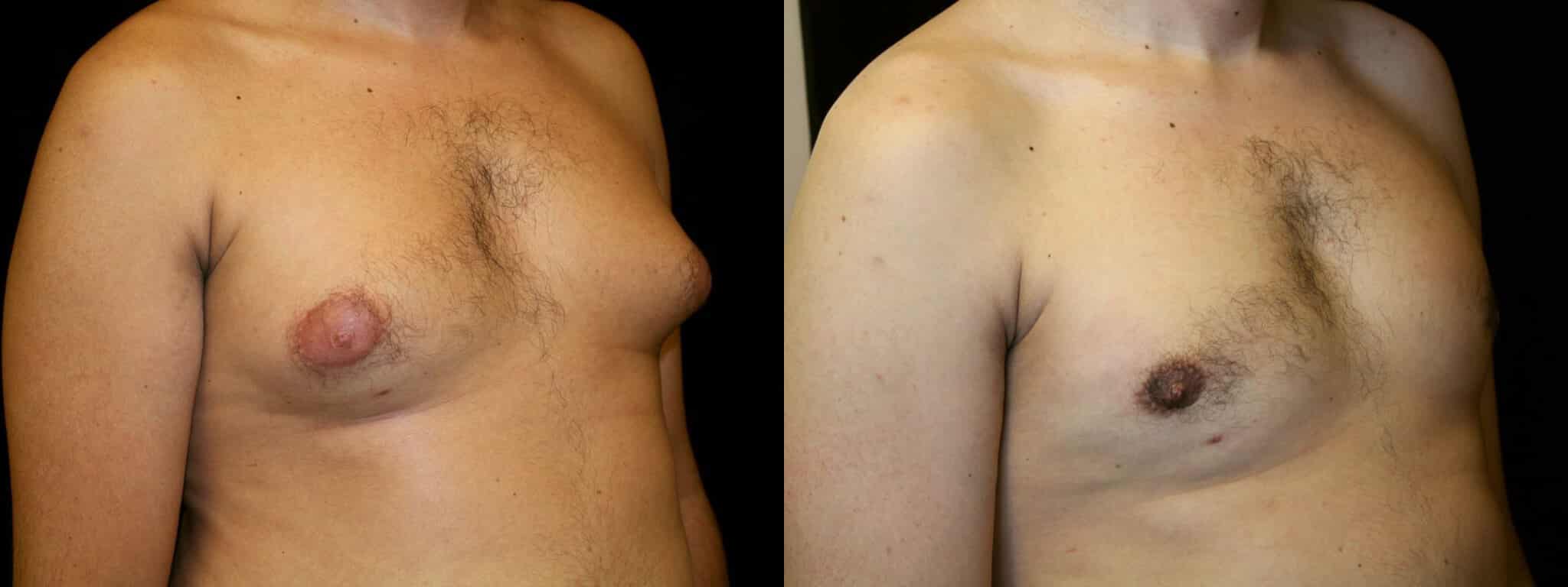 Gynecomastia Patient 7 Before & After Details