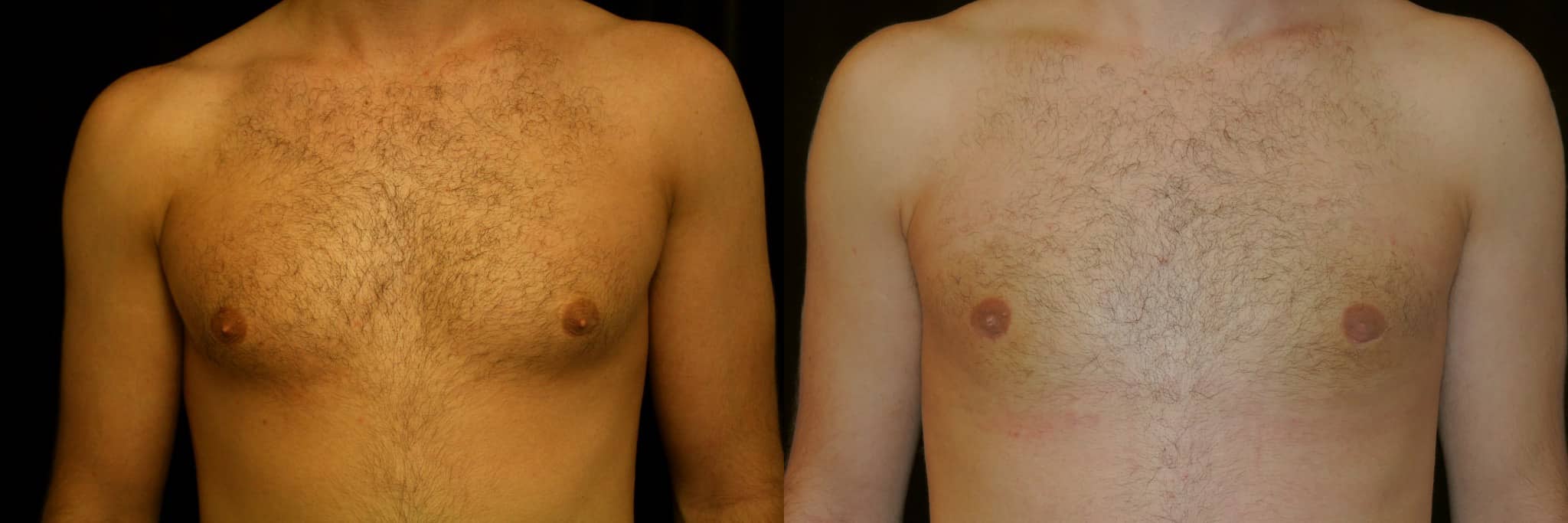 Gynecomastia Patient 13 Before & After