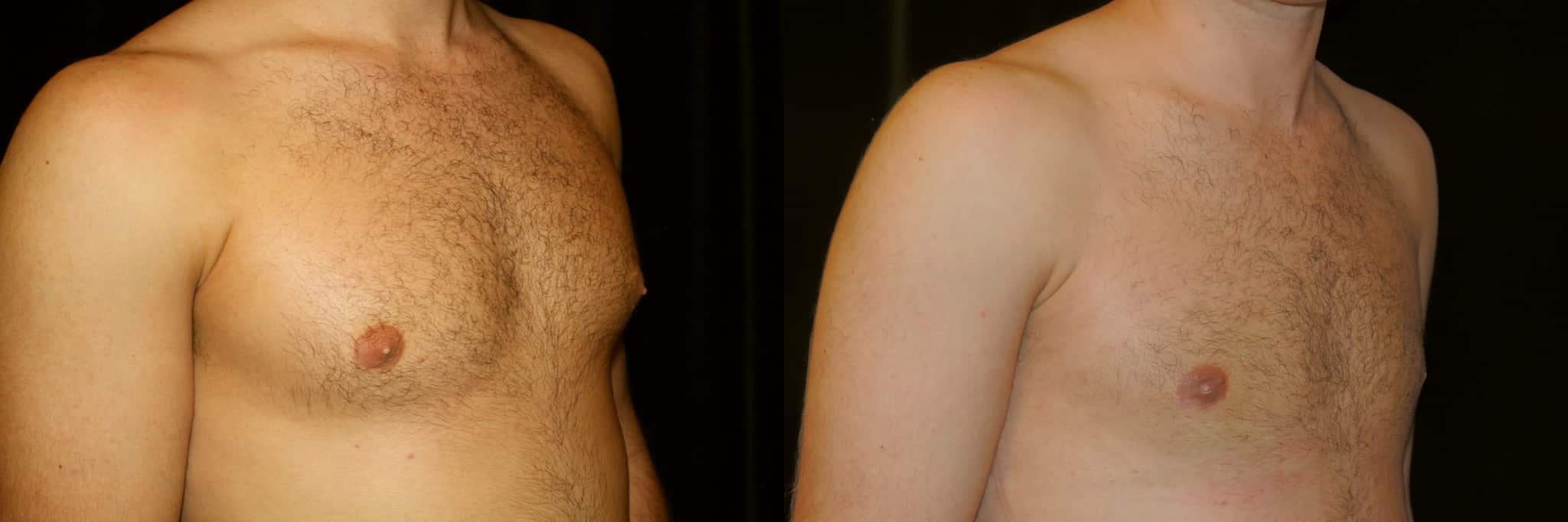 Gynecomastia Patient 13 Before & After Details