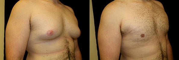 Gynecomastia Patient 20 Before & After Details