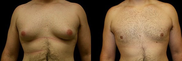 Gynecomastia Patient 20 Before & After