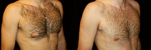 Gynecomastia Patient 11 Before & After Details