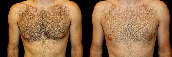 Gynecomastia Patient 11 Before & After