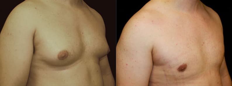 Gynecomastia Patient 4 Before & After Details