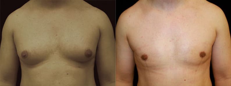 Gynecomastia Patient 4 Before & After