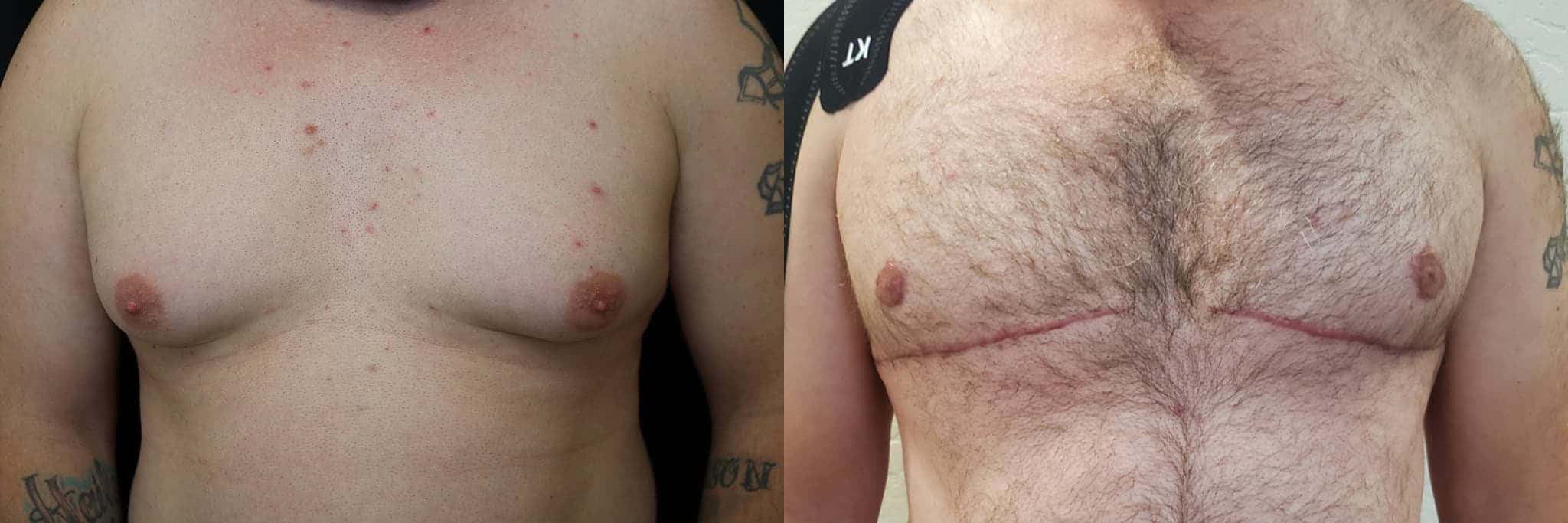 Gynecomastia Patient 9 Before & After