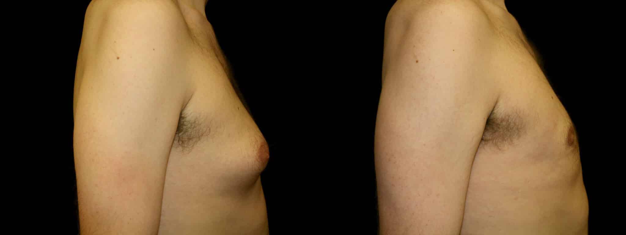 Gynecomastia Patient 11 Before & After Details