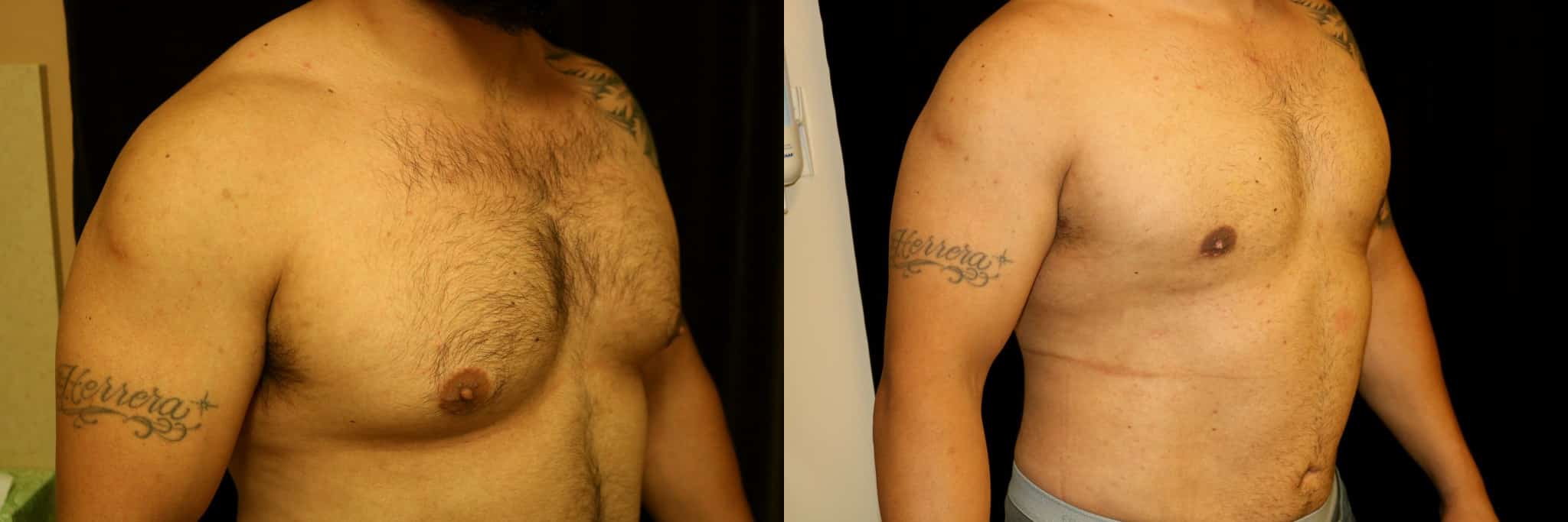 Gynecomastia Patient 8 Before & After Details