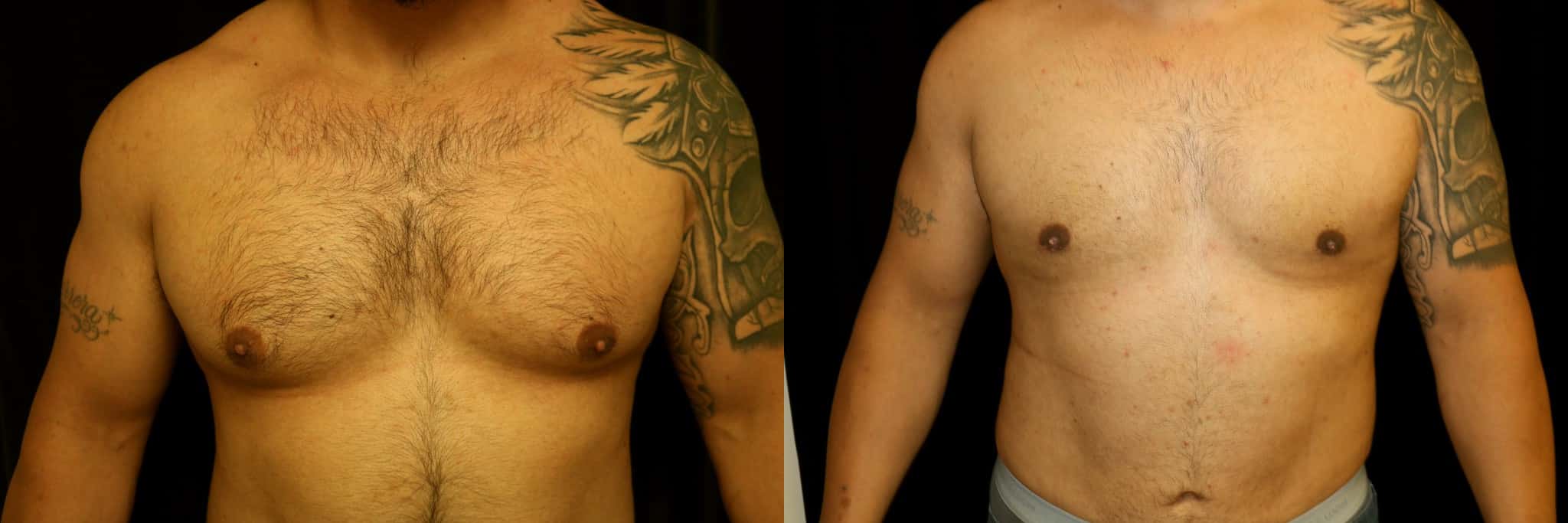 Gynecomastia Patient 8 Before & After